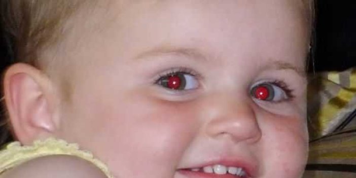 Çocuk fotoğraflarında kırmızı çıkan göz bebeği neyin habercisi?