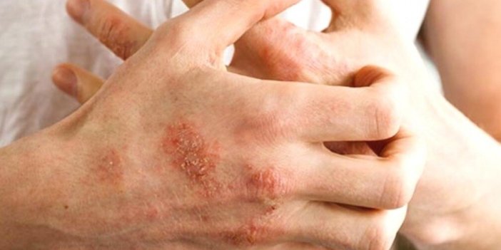 Sonbaharda alerjik egzamaya dikkat. Dermatoloji Uzmanı uyardı