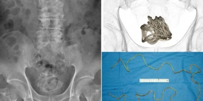 Röntgen çeken doktorlar gözlerine inanamadı. Cinsel organına soktuğu ip doktorları şoke etti. İdrarını yapamayınca doktora gitmişti