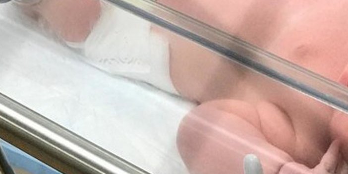 3,5 kiloluk bebeğin alınan böbreği 250 gram çıktı