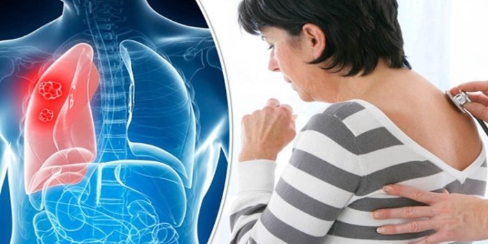 Geçmeyen her sırt ağrısı akciğer kanseri belirtisi mi?