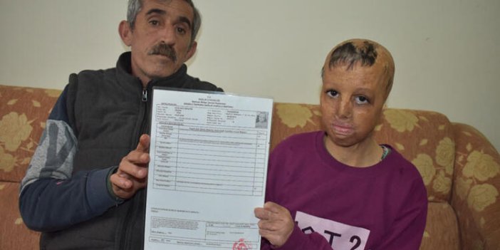 13 yaşındaki kız yüzüne kavuşmak istiyor. Evlerine düşen bombayla yüzü yandı. 109 ameliyat oldu