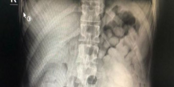 Hastanın röntgenine bakan doktor şok geçirdi
