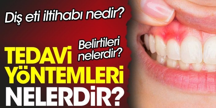 Diş eti iltihabı nedir? Belirtileri nelerdir? Tedavi yöntemleri nelerdir?