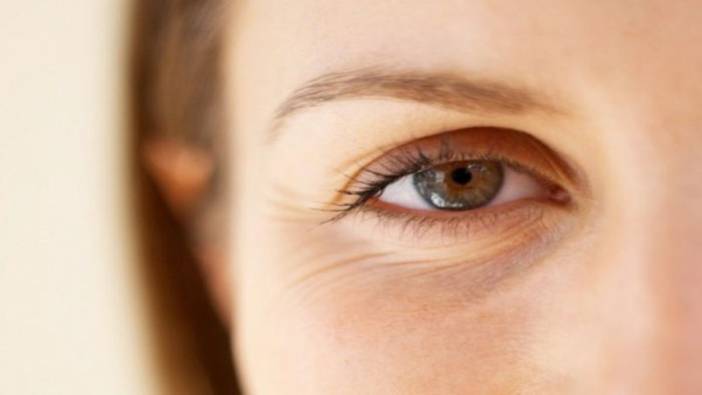 Göz çevresi kırışıklığı botokssuz geçer mi? Göz çevresi kırışıklığı nasıl geçer?