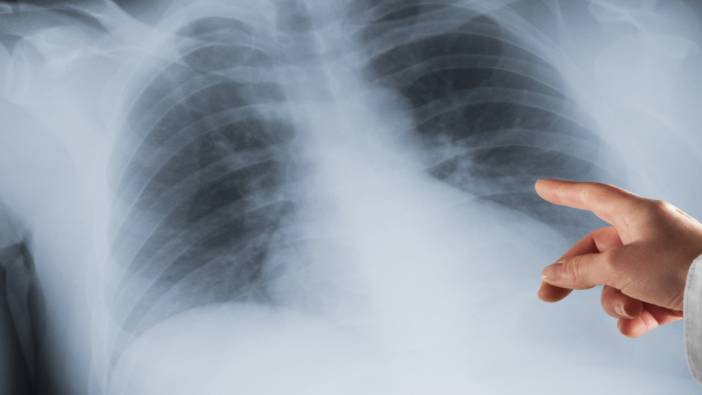 Akciğer kanserine iyi gelen ot