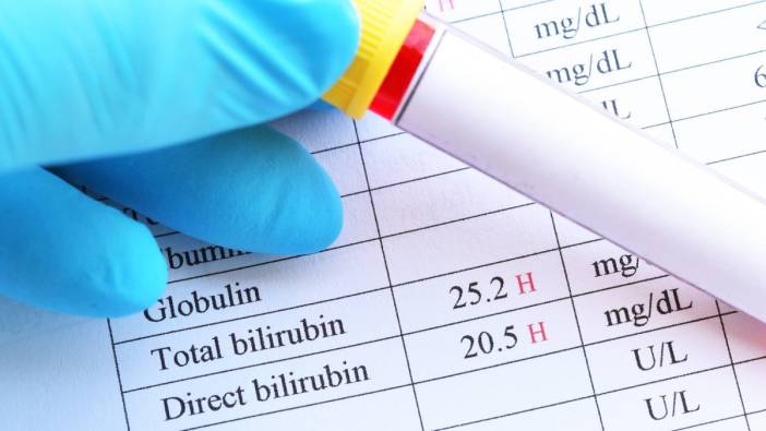 Bilirubin nedir