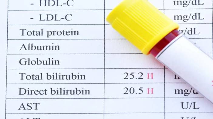 Bilirubin yüksekliği değerleri nasıl düşer?