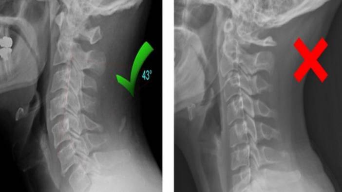 Boyun düzleşmesi neden olur