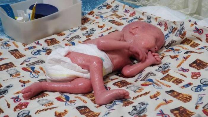 300 milyonda bir görülen Yılan bebek' davasında 2,5 yıl sonra karar: Babası 'soybağının reddi' davası açmıştı