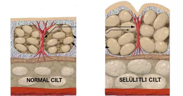 selulit-nedir-neden-olusur-nasil-tedavi-edilir-selulit-neden-olur-nasil-gecer-1541760485.webp