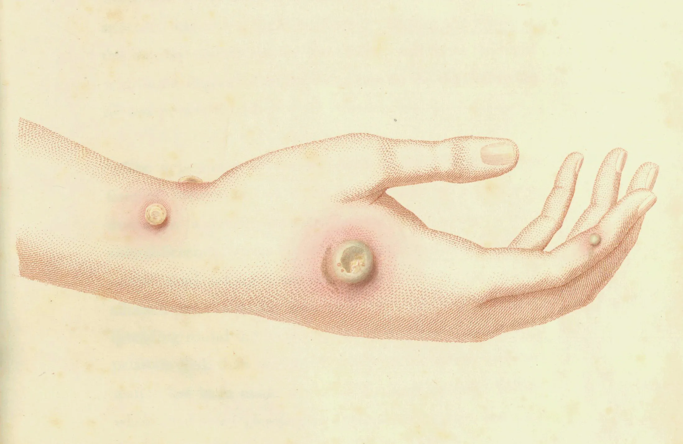 1-the-cowpox-afflicted-hand-of-sarah-nelmes.webp