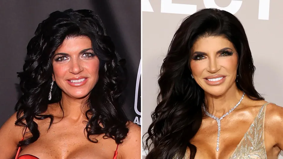 teresa-giudice-plastic-surgery-transformation-1.webp