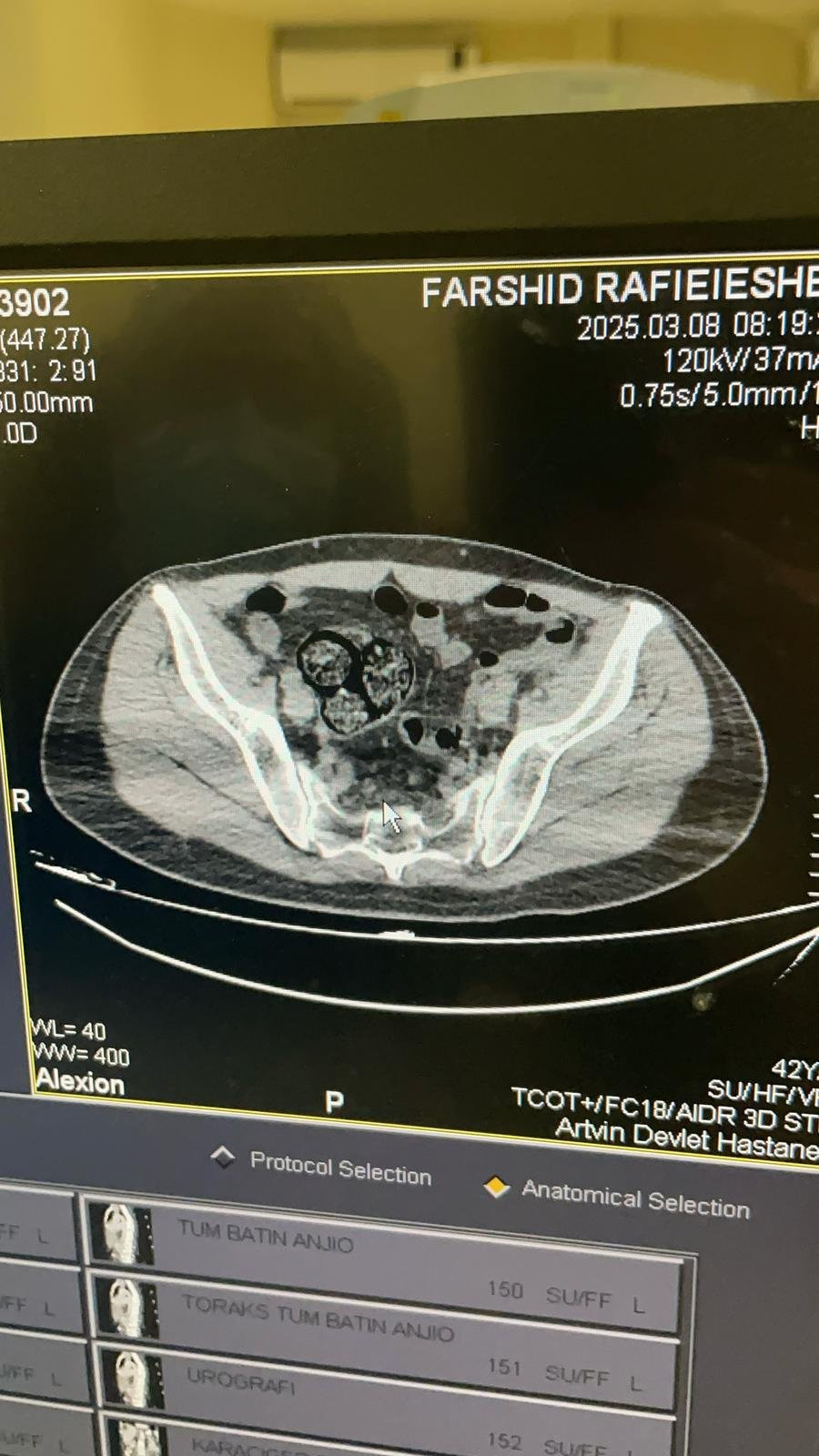 Bağırsağından paket paket uyuşturucu çıktı!