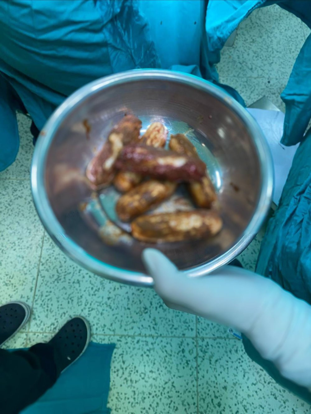 Bağırsağından paket paket uyuşturucu çıktı!