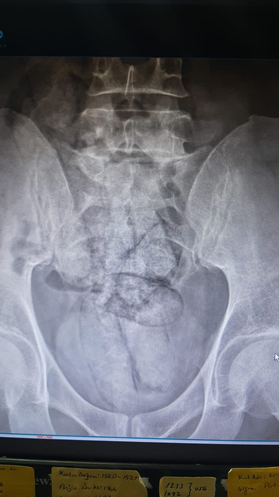 Bağırsağından paket paket uyuşturucu çıktı!