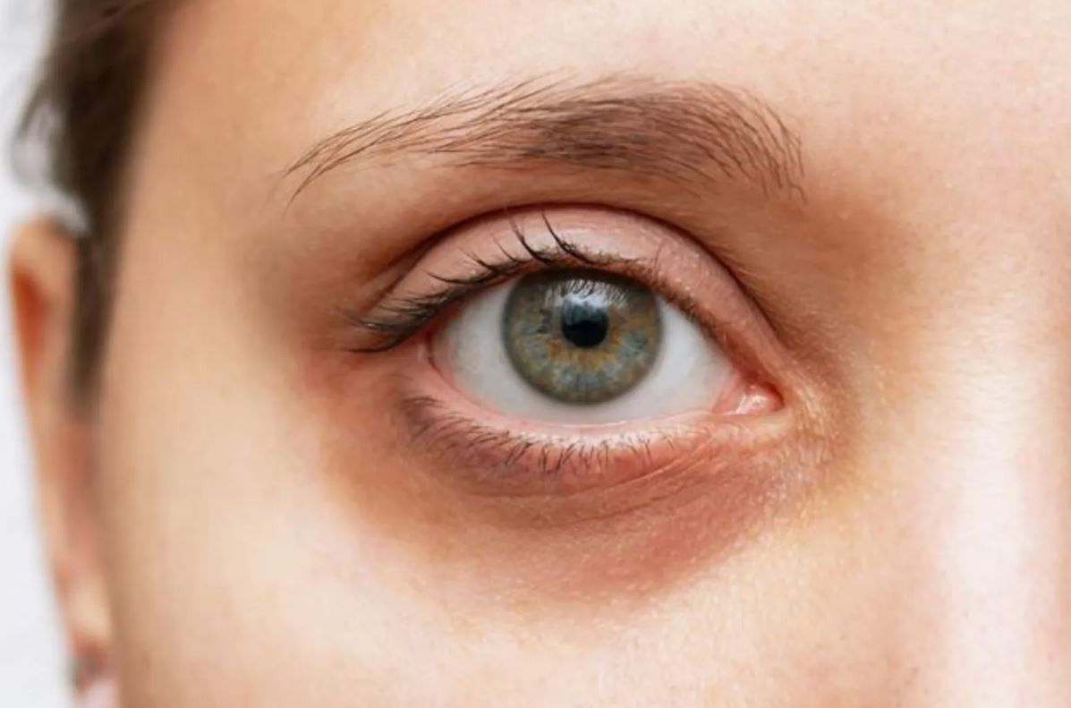 goz-alti-morluklarinin-gercek-sebebi-neden-hep-yorgun-gorunuyoruz-yenicag-6.jpg