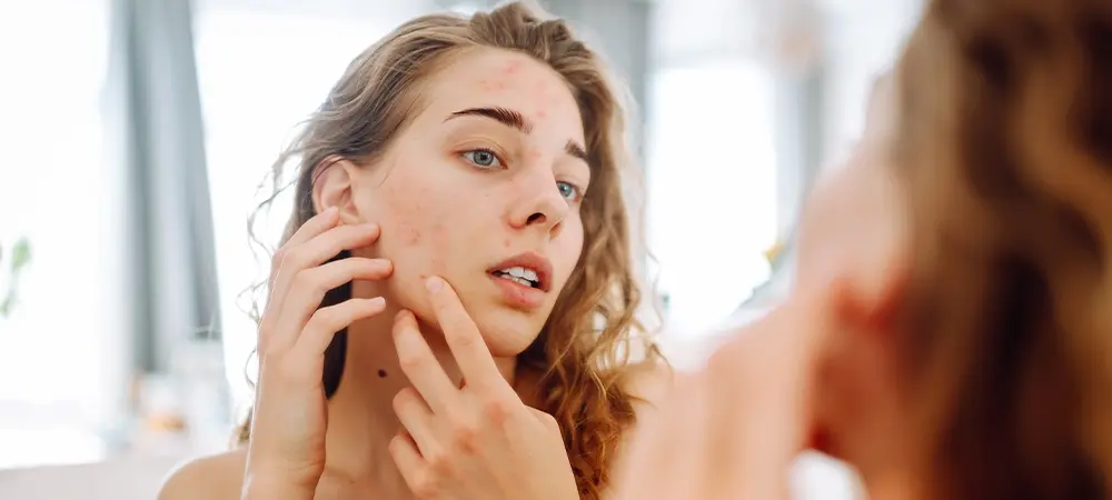 close-up-of-a-young-woman-looking-at-pimples-in-th-2024-03-05-16-01-38-utc-19-12978-webimage-b.webp