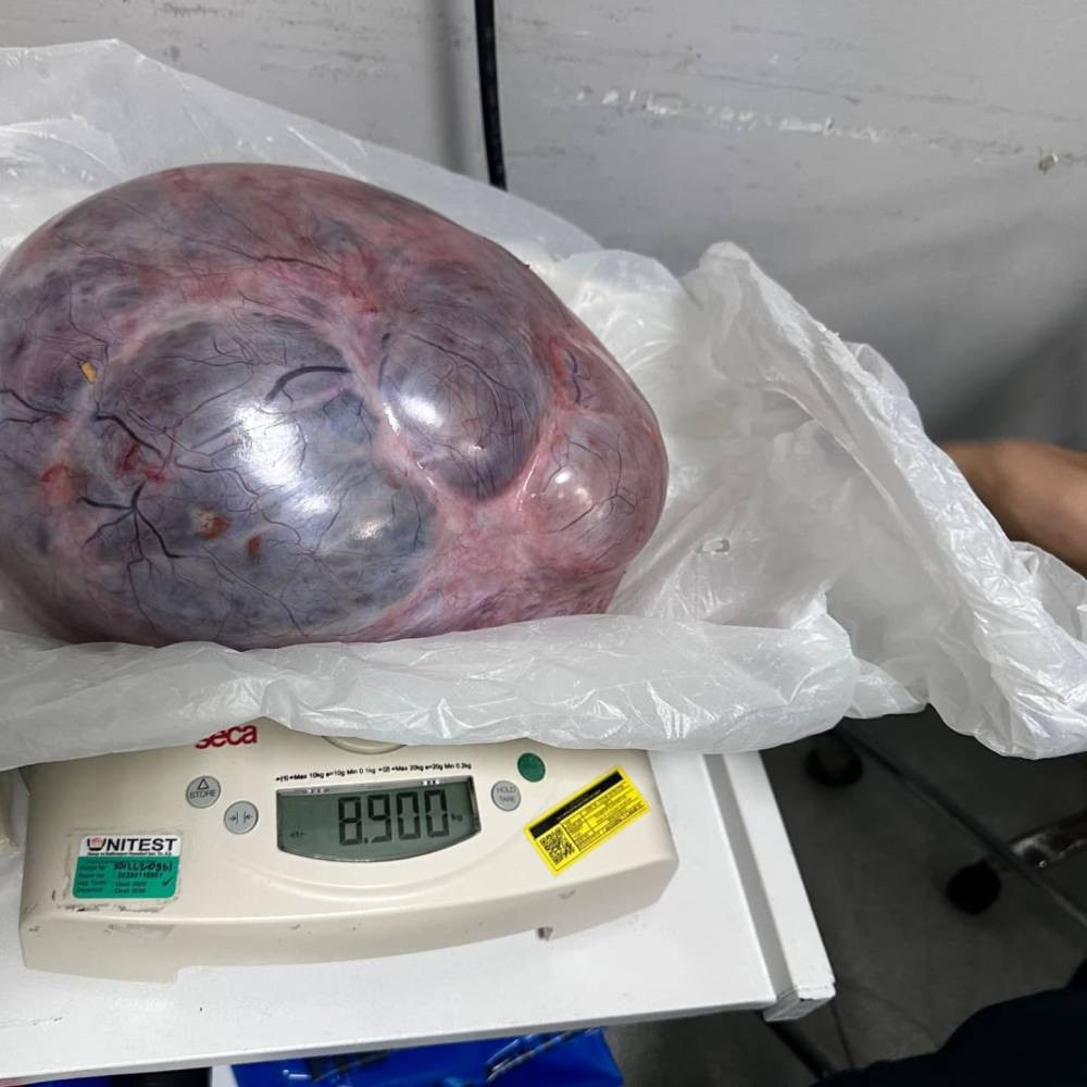 Yumurtalıktan çıkan dev kitle şoke etti! Doktorlar bile hayrete düşürdü