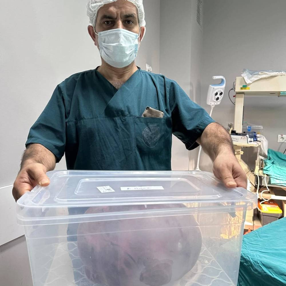 Yumurtalıktan çıkan dev kitle şoke etti! Doktorlar bile hayrete düşürdü