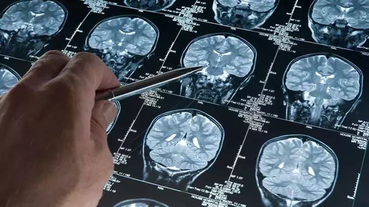 alzheimerin-8-gizli-tetikleyicisi-ortaya-cikti-kadinlar-mi-erkekler-mi-daha-tehlikede-yenicag-17.jpg